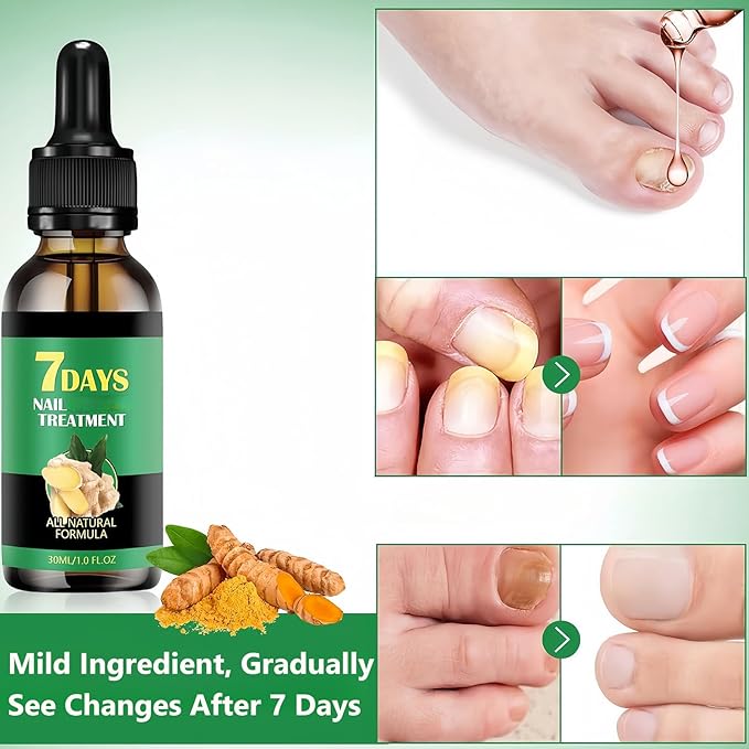 Ginger Nail Treatment-Nail Strengthener for Damaged Nails-Mild Nail Growth Serum for Gingernail & Toenail-Easy to Use, 1Pc 30ML