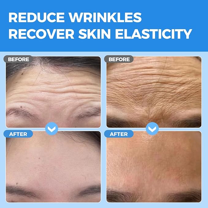 Okela Forehead Wrinkle Patches Overnight 20 pcs with Collagen, Vitamin, Anti Wrinkle Patches, Forehead Wrinkles Beauty Treatment