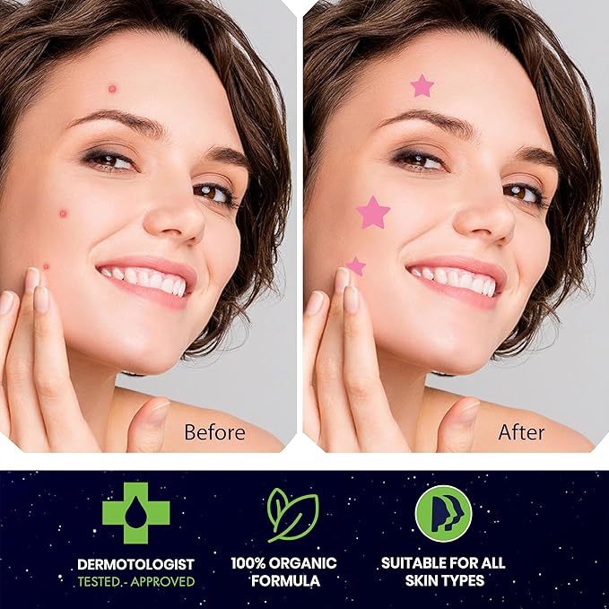 Star Pimple Patches for Face – Hydrocolloid Acne Patches for Quick Zit Relief And Blemishes, Invisible Spot Stickers That Stay All Night, Gentle for All Skin Types, Oil-Free (80 Count)