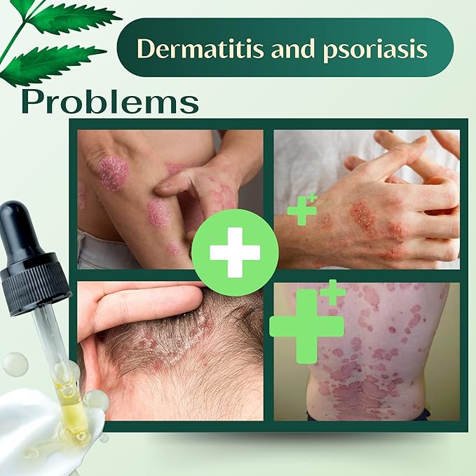 ABERA Alan Silver Serum - Clinically Proven to Soothe Irritated Skin and Improve The Appearance of Skin with Mild to Moderate Psoriasis (2 Boxes)