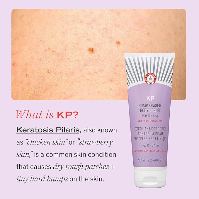 First Aid Beauty - KP Bump Eraser Body Scrub with 10% AHA, Keratosis Pilaris Skin Exfoliator with Glycolic and Lactic acids, Helps Reduce Chicken Skin Bumps, Safe for Sensitive Skin, 2 oz