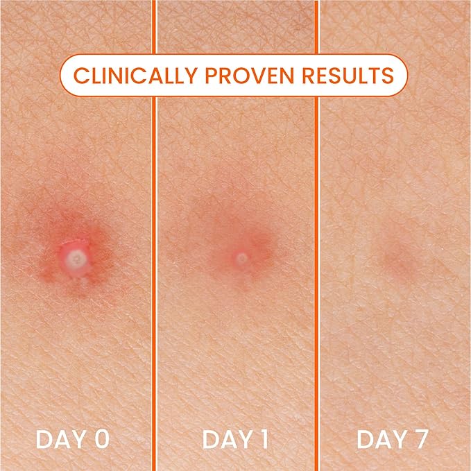 Bioré Pimple Patches, Cover & Conquer Blemish Patch, Medical Grade Ultra-Thin Hydrocolloid for Covering Zits and Blemishes, HSA/FSA Approved, 30 Count