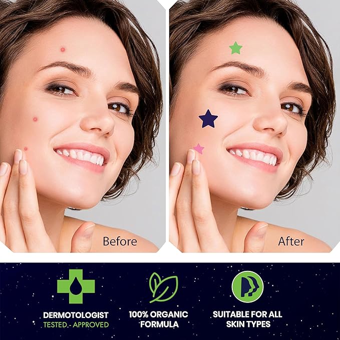 Star Pimple Patches for Face – Hydrocolloid Acne Patches for Quick Zit Relief and Blemishes, Invisible Spot Stickers That Stay All Night, Gentle for All Skin Types, Oil-Free (240 Count)