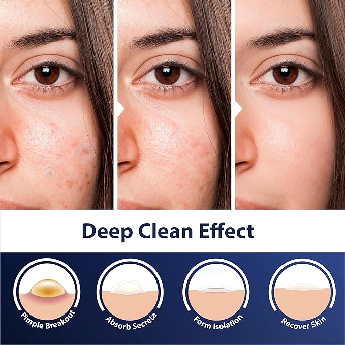 Dot Pimple Patches for Face – Hydrocolloid Acne Patches for Quick Zit Relief And Blemishes, Invisible Spot Stickers That Stay All Night, Gentle for All Skin Types, Oil-Free (80 Count)