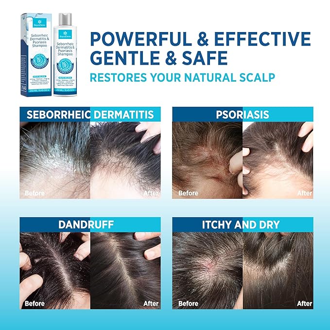 Seborrheic Dermatitis & Psoriasis Cream, Shampoo and Conditioner Set - Scalp Therapy System for Folliculitis, Psoriasis, Dandruff, Dry Scalp - Scalp Treatment to Relieve Itching, Flaking, Irritation