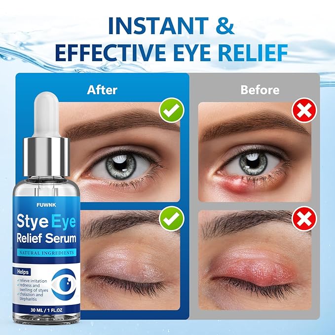 Stye Eye Treatment Serum, Eye Stye Remover for Chalazion, Blepharitis & Stye Removal, Natural Stye Eye Drops, Safe & Fast Relief, 30ml