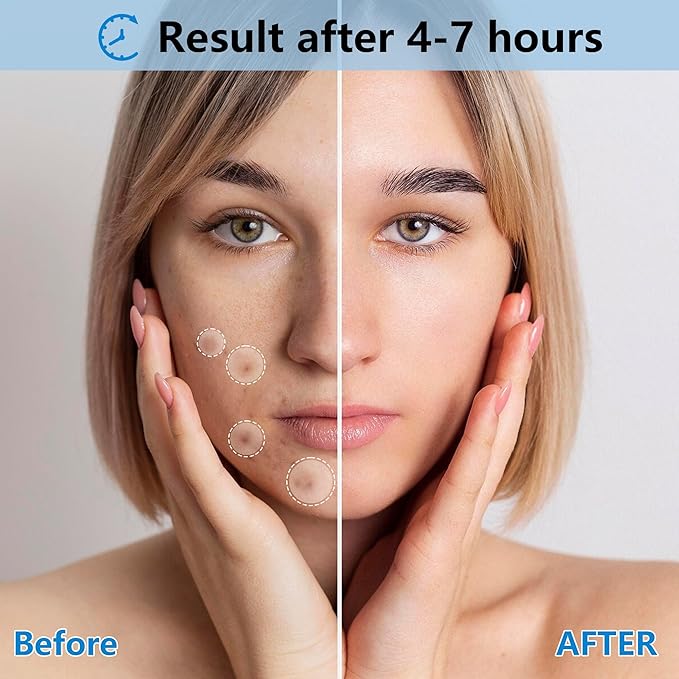 2 PACK 360 Counts Pimple Patches for Face, 4 Size Acne Patches, Hydrocolloid Patches for Covering Zits and Blemishes, Spot Stickers with Salicylic Acid, Tea Tree Oil & Centella