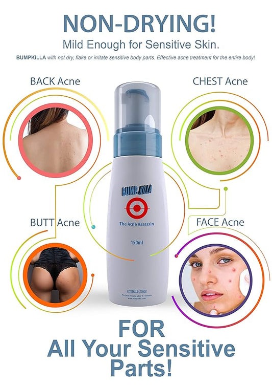 Acne Treatment For Sensitive Skin - 80% of Acne Gone in 4 Weeks. (Double Bottle)