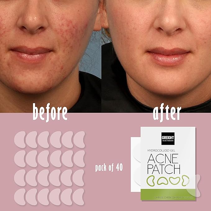 pimple patches for face - (40 Count) acne patches Hydrocolloid for Covering Zits and Blemishes Zits and Breakouts with - Vegan, Cruelty Free, Carbonfree (40 PATCHES)