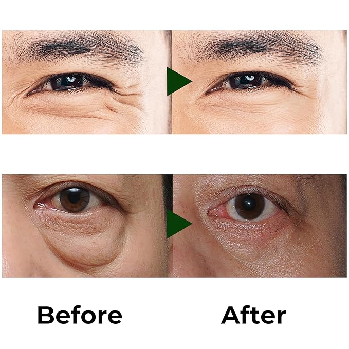 Combo Abera Saffron Serum For Melasma Treatment & Abera Eye Roller Serum With Mint For Dark Circles and Puffiness