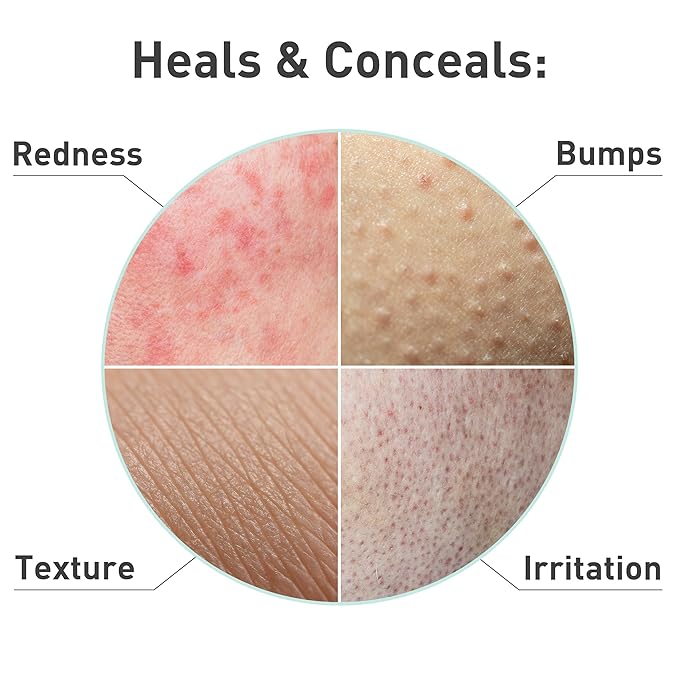 PROcure Rosacare Soothing Sheet Face Mask with Hyaluronic Hydrogel for Rosacea Symptoms, 5 Masks