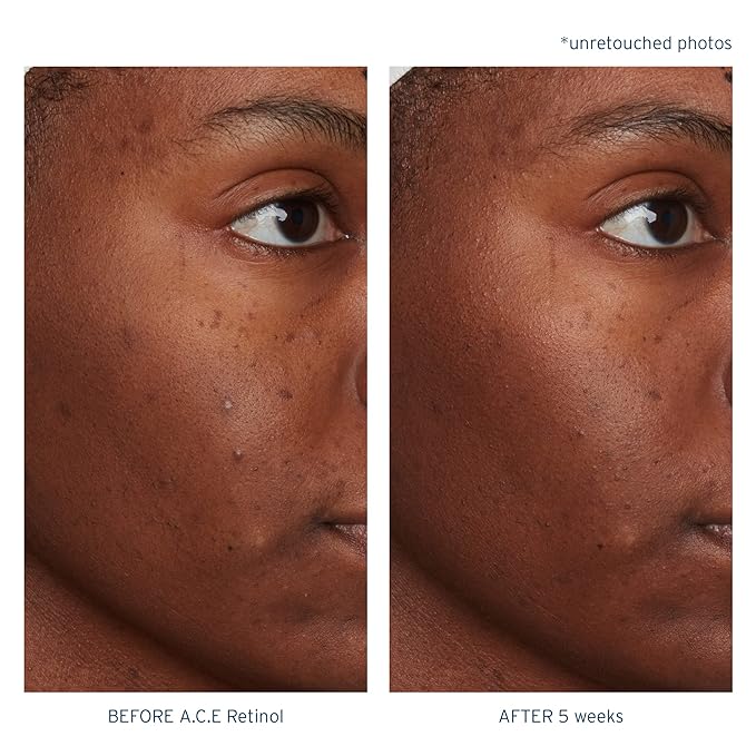 Santo Remedio, Piel Eterna, A.C.E. Retinol Intensive Rejuvenation Oil, Vitamin A, Vitamin C, Vitamin E, Squalane, Salicylic Acid, For Normal, Oily, or Combination Skin, 1 Fl. Oz.