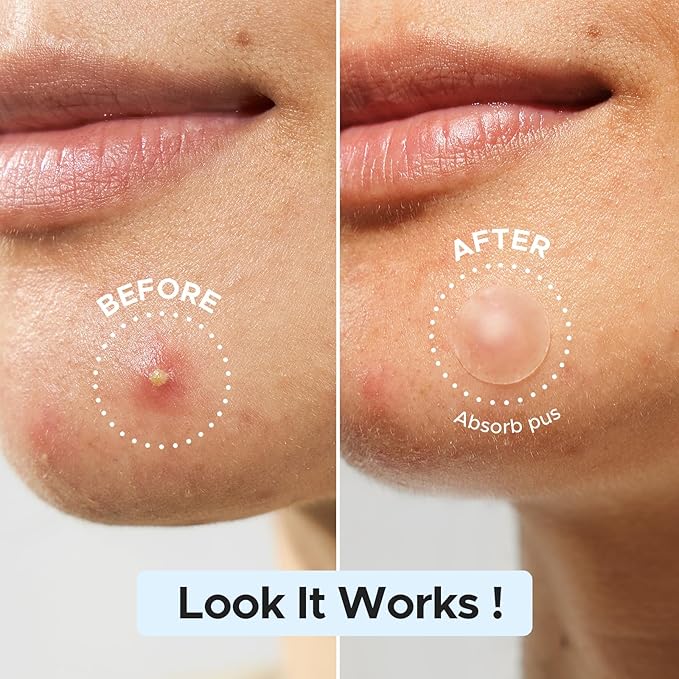 LitBear Pimple Patch Bulk (720 Patches 3 Size) Pimple Patches for Face (5 Sizes, 507Patches)