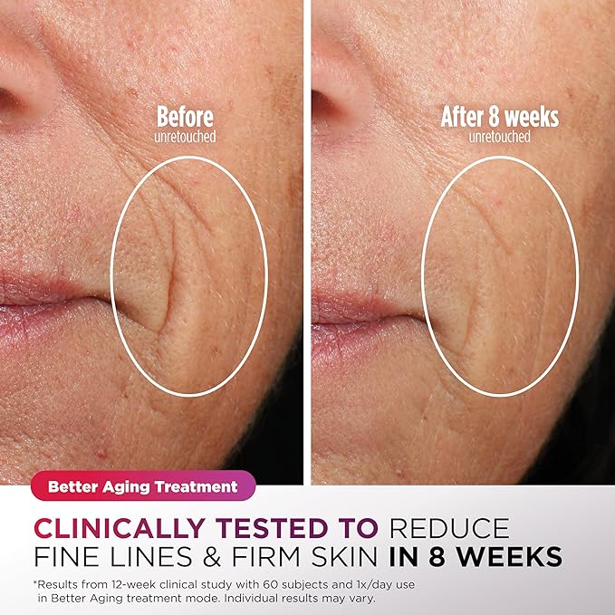 Shark CryoGlow LED Face Mask (FSA/HSA Eligible*) with Under-Eye Cooling, Anti-Ageing & Blemish Repair, Red & Blue LED, Infrared Light Therapy, USB-C, Remote Control, Storage Bag, Lilac Chill, FW312PL